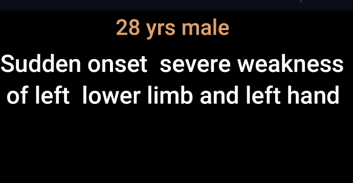 Epidural Hematoma